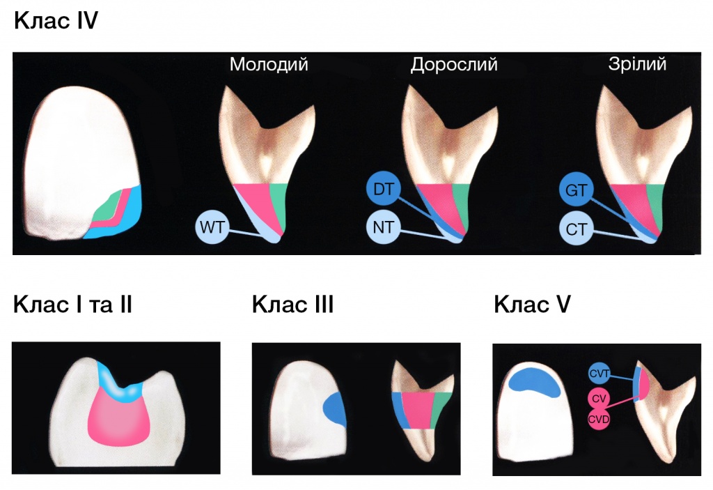 Gradia_teeth.jpg Gradia_teeth.jpg