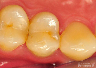 Клінічний випадок застосування G-aenial Posterior та everX Posterior 