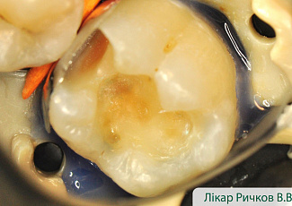 Реставрація з G-AENIAL  з використанням барвника OPTIGLAZE Color 
