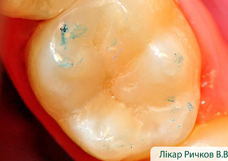 Реставрація з G-AENIAL  з використанням барвника OPTIGLAZE Color 