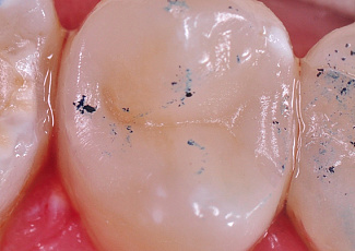 Реставрація  за допомогою G-AENIAL  Posterior та OPTIGLAZE Color