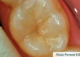 Реставрація з G-AENIAL  з використанням барвника OPTIGLAZE Color 