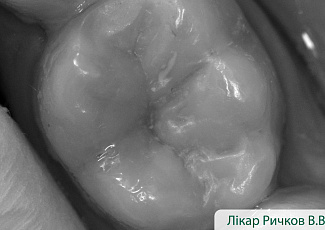Реставрація з G-AENIAL  з використанням барвника OPTIGLAZE Color 