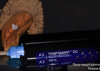 Тимчасова консольна конструкція з TEMPSMART DC (композит подвійного твердіння)