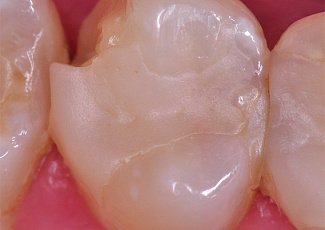 Реставрація  за допомогою G-AENIAL  Posterior та OPTIGLAZE Color