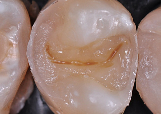 Реставрація  за допомогою G-AENIAL  Posterior та OPTIGLAZE Color