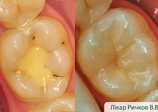 Реставрація з G-AENIAL  з використанням барвника OPTIGLAZE Color 
