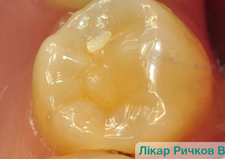 Реставрація з G-AENIAL  (порожнина II класу)