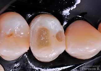 Клінічний випадок застосування G-aenial Posterior та everX Posterior 