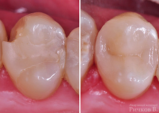 Реставрація  за допомогою G-AENIAL  Posterior та OPTIGLAZE Color