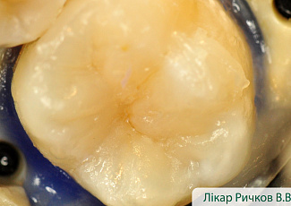Реставрація з G-AENIAL  з використанням барвника OPTIGLAZE Color 