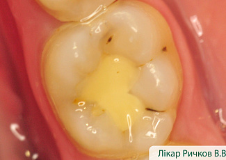 Реставрація з G-AENIAL  з використанням барвника OPTIGLAZE Color 