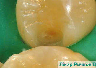Реставрація з G-AENIAL  (порожнина II класу)