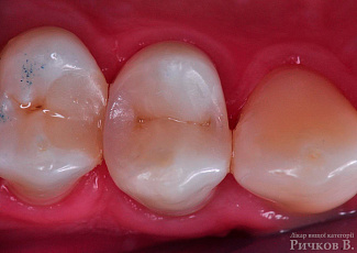 Клінічний випадок застосування G-aenial Posterior та everX Posterior 