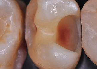 Реставрація  за допомогою G-AENIAL  Posterior та OPTIGLAZE Color