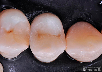 Клінічний випадок застосування G-aenial Posterior та everX Posterior 