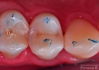 Клінічний випадок застосування G-aenial Posterior та everX Posterior 