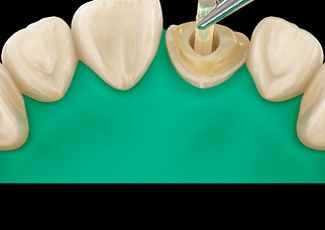 GC Restorative Guide 2.0: Довідник з Відновлювальної Стоматології