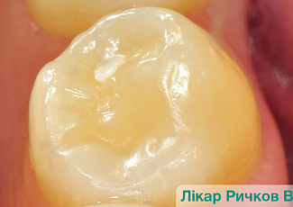 Реставрація з G-AENIAL  (порожнина II класу)