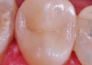 Реставрація  за допомогою G-AENIAL  Posterior та OPTIGLAZE Color