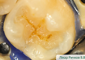 Реставрація з G-AENIAL  з використанням барвника OPTIGLAZE Color 