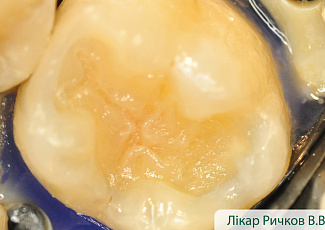 Реставрація з G-AENIAL  з використанням барвника OPTIGLAZE Color 